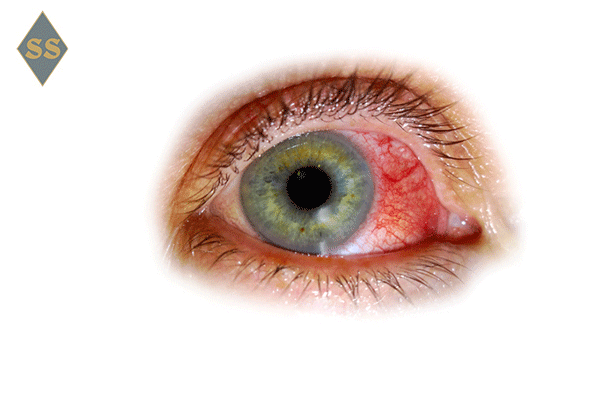 Глаз с конъюнктивитом